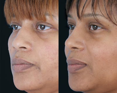 Rhinoplasty Before & After Gallery - Patient 956471 - Image 1