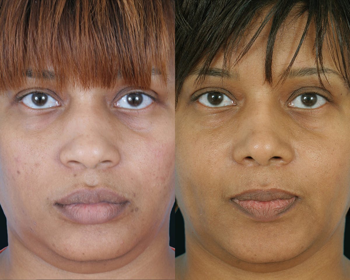 Rhinoplasty Before & After Gallery - Patient 956471 - Image 2
