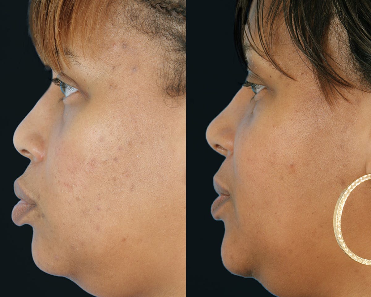 Rhinoplasty Before & After Gallery - Patient 956471 - Image 3