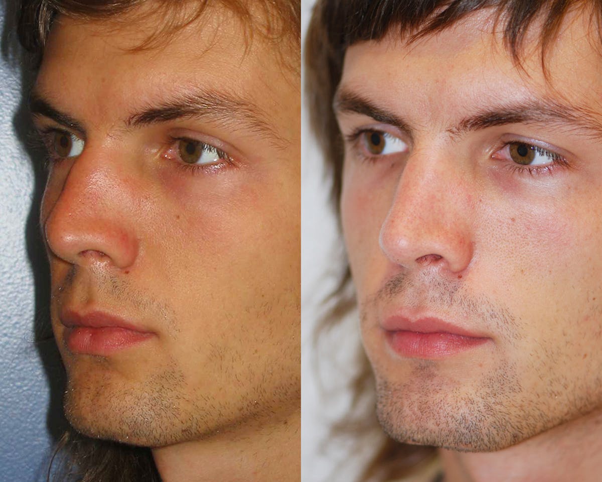 Rhinoplasty Before & After Gallery - Patient 234906 - Image 1