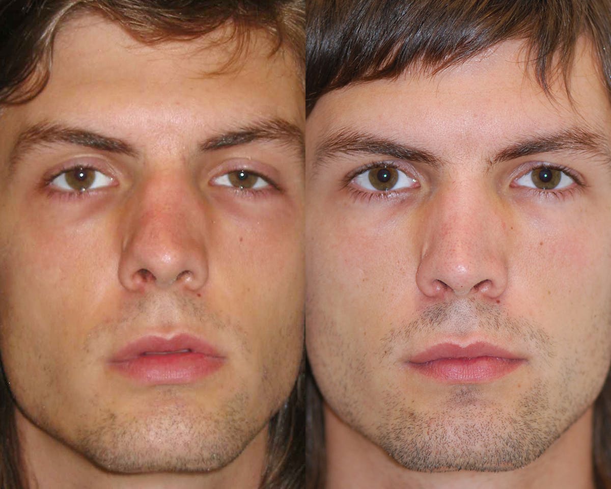 Rhinoplasty Before & After Gallery - Patient 234906 - Image 2
