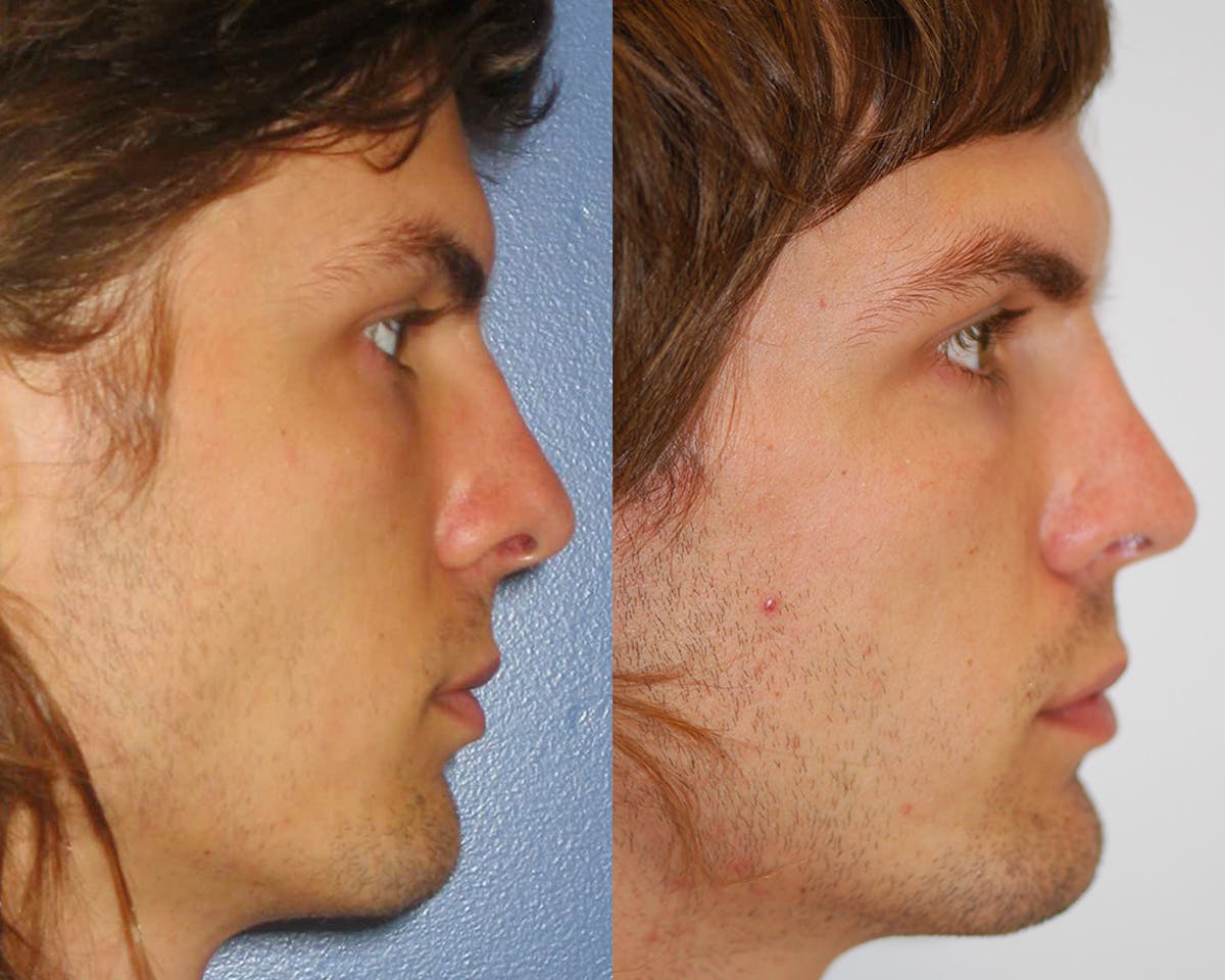Rhinoplasty Before & After Gallery - Patient 234906 - Image 3