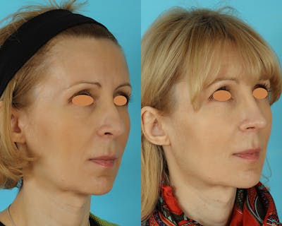 Rhinoplasty Before & After Gallery - Patient 293044 - Image 1