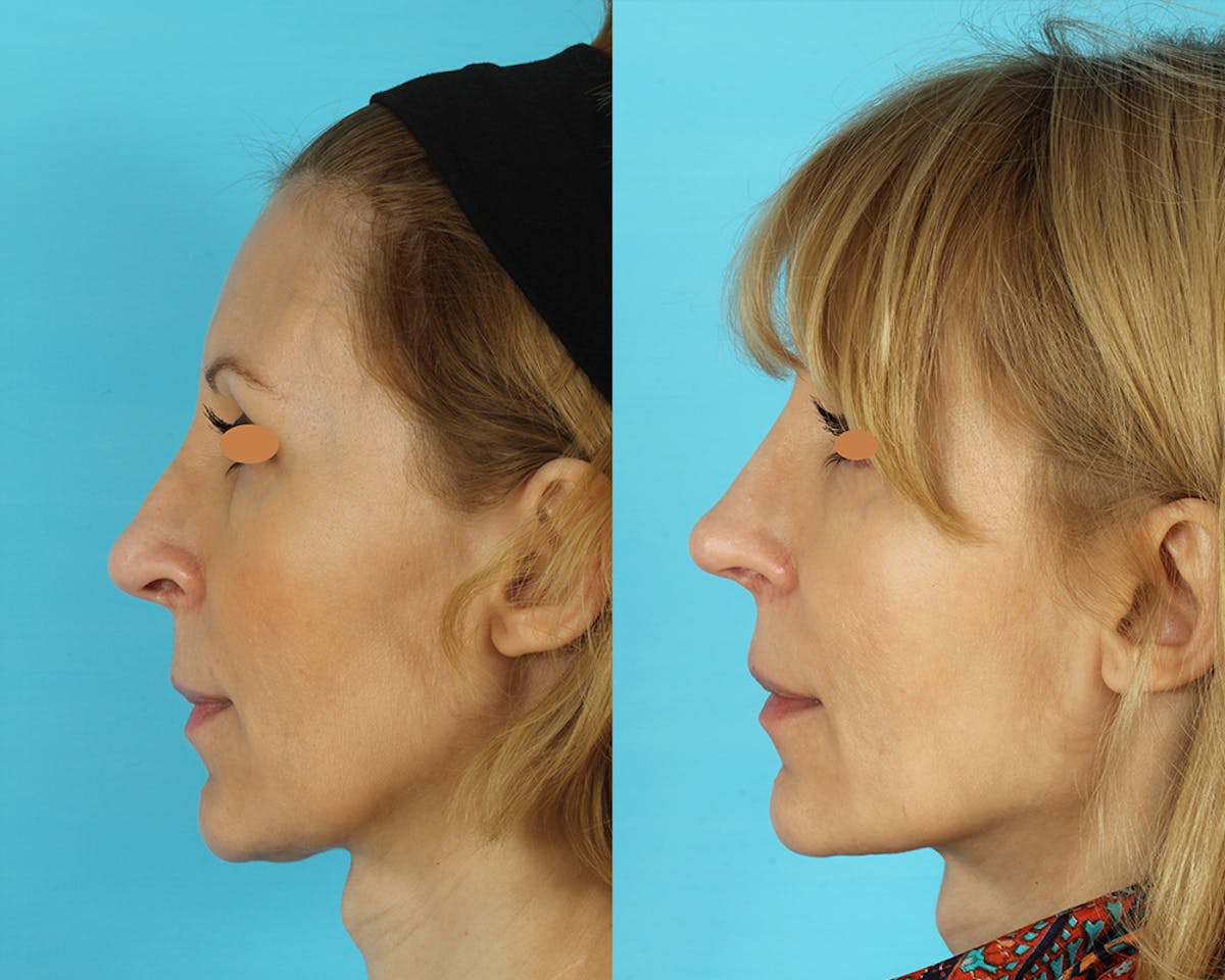 Rhinoplasty Before & After Gallery - Patient 293044 - Image 3