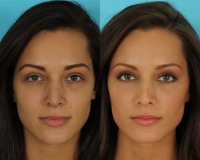 Rhinoplasty Before & After Gallery - Patient 351740 - Image 1