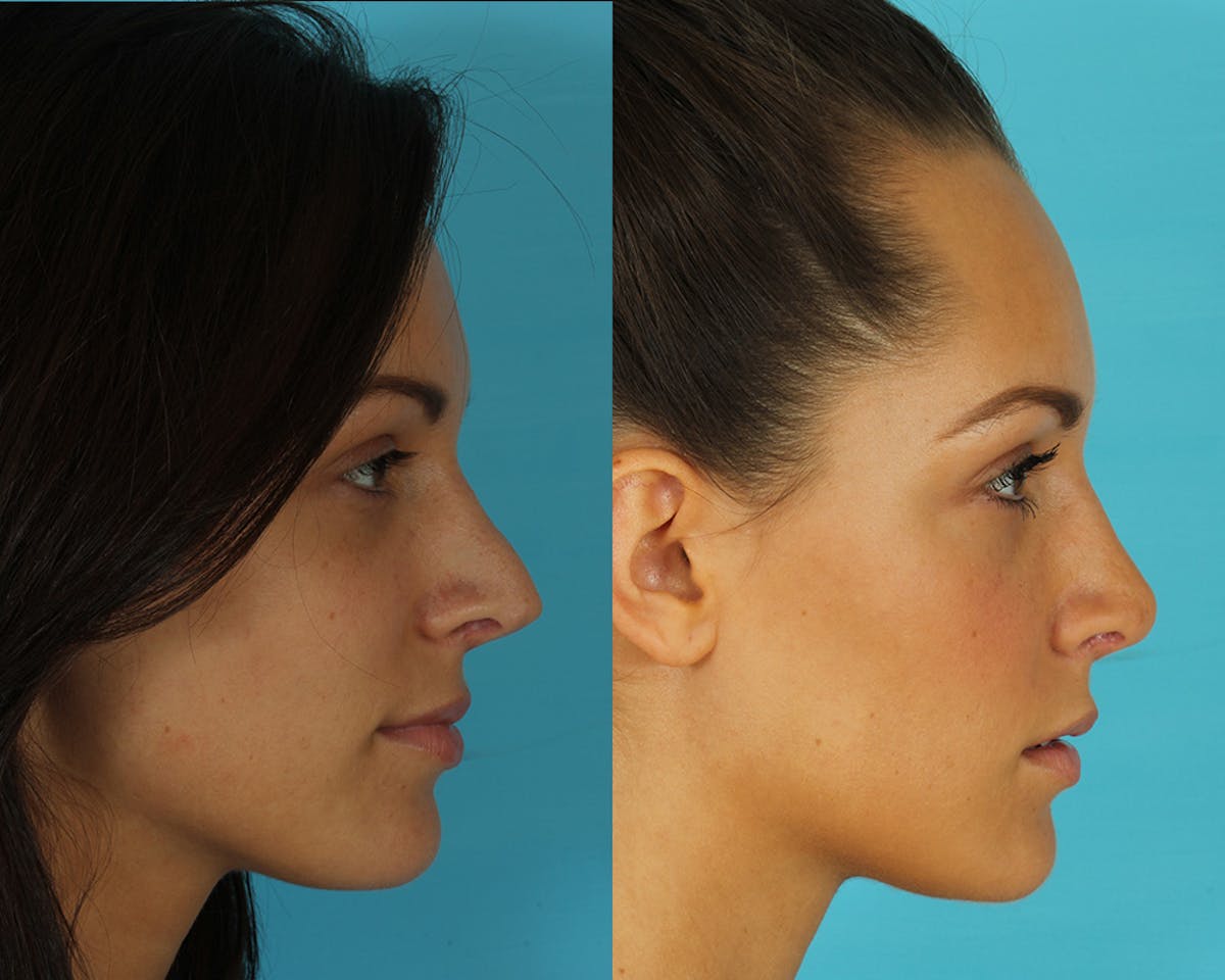 Rhinoplasty Before & After Gallery - Patient 351740 - Image 3