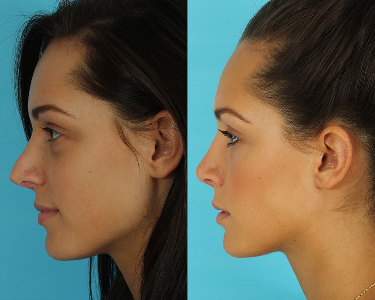 Rhinoplasty Before & After Gallery - Patient 351740 - Image 2