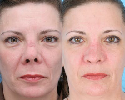 Rhinoplasty Before & After Gallery - Patient 403670 - Image 1