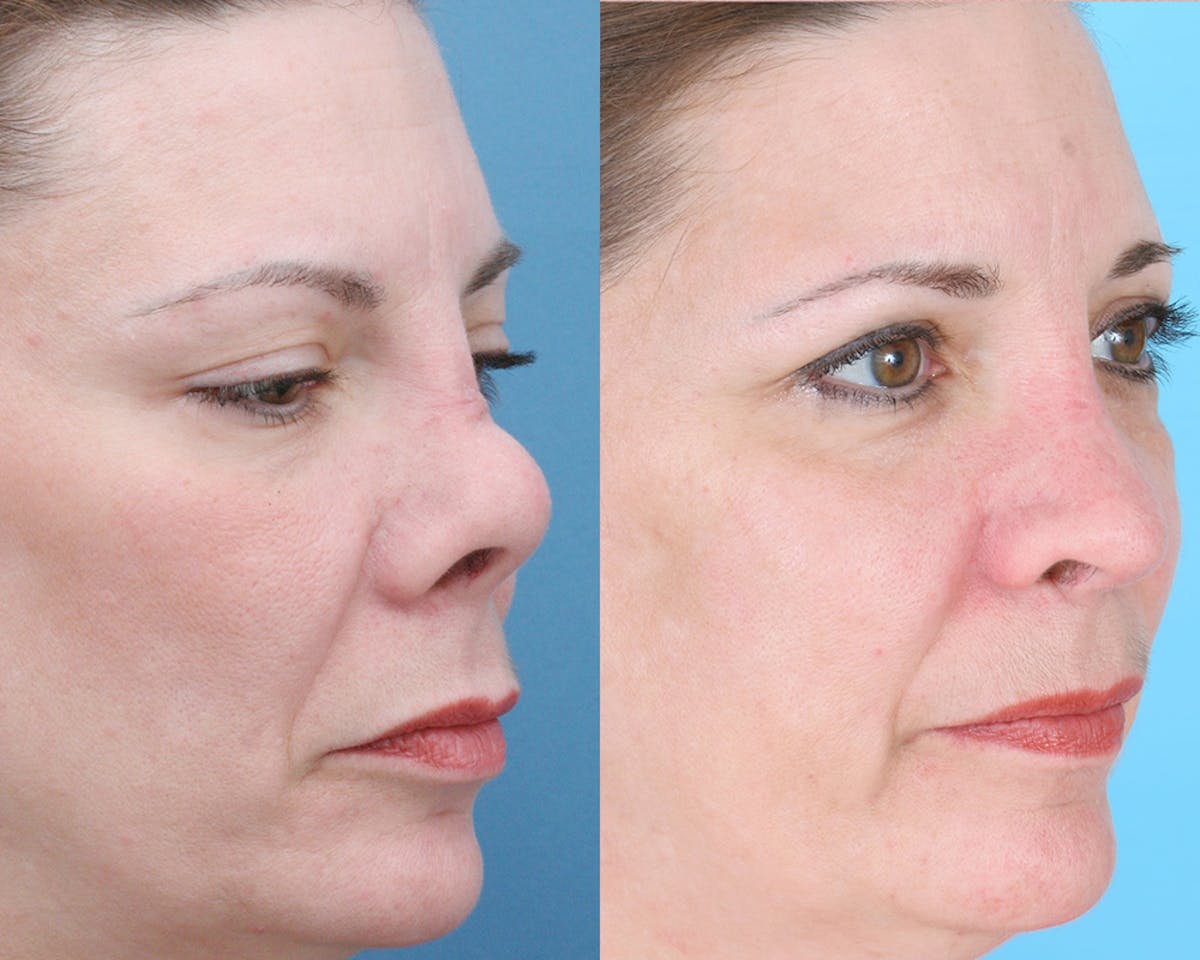 Rhinoplasty Before & After Gallery - Patient 403670 - Image 3