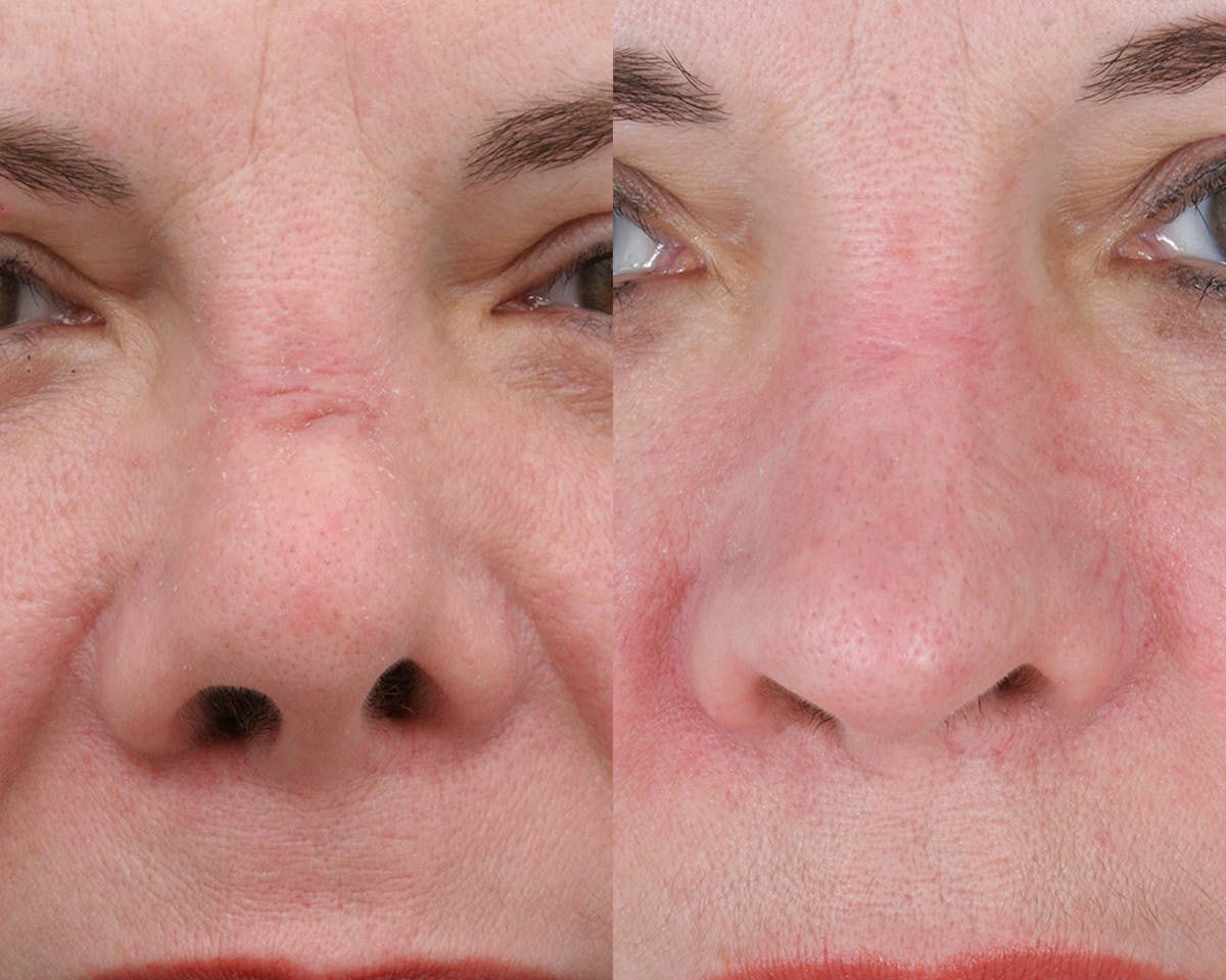 Rhinoplasty Before & After Gallery - Patient 403670 - Image 2
