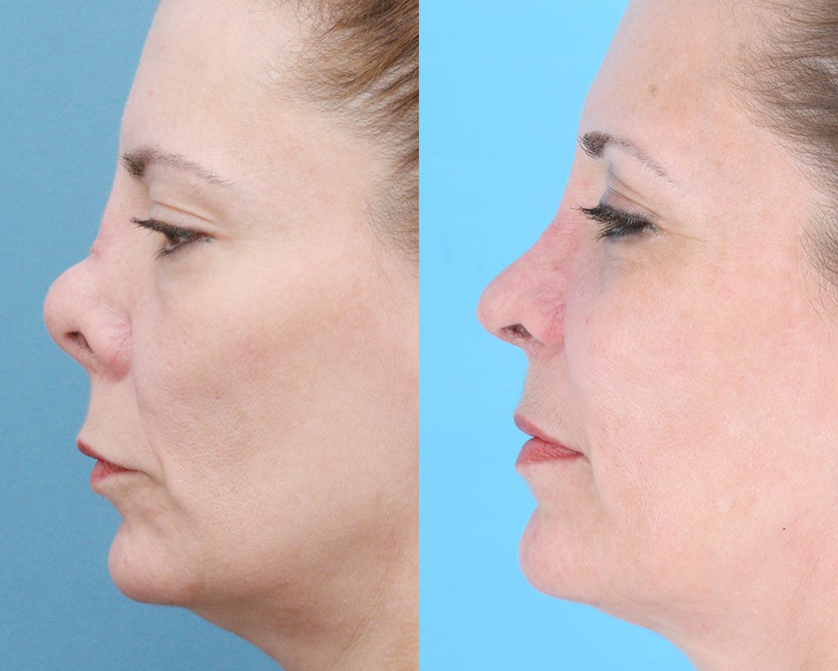 Rhinoplasty Before & After Gallery - Patient 403670 - Image 5