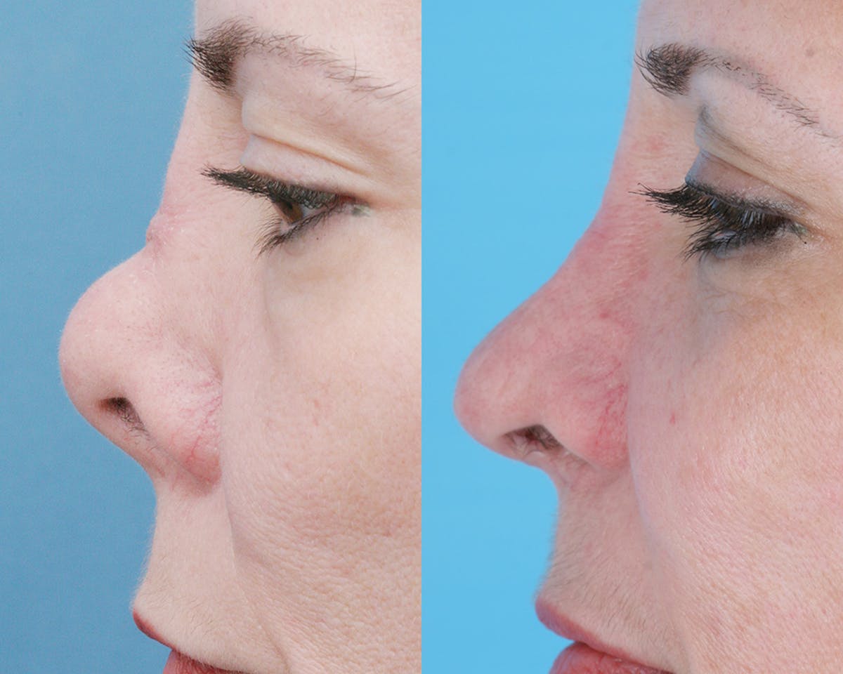 Rhinoplasty Before & After Gallery - Patient 403670 - Image 4