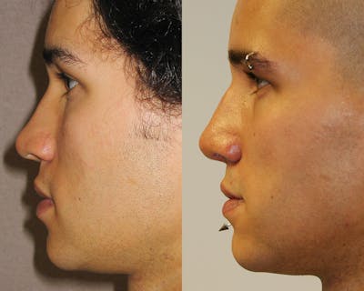 Rhinoplasty Before & After Gallery - Patient 243972 - Image 1