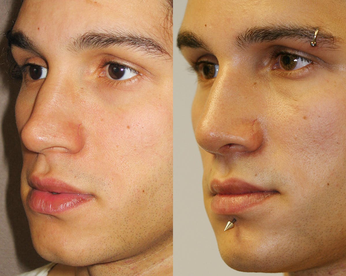 Rhinoplasty Before & After Gallery - Patient 243972 - Image 2