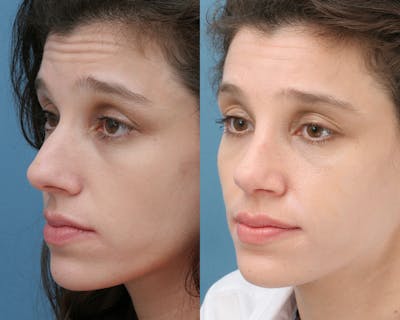 Rhinoplasty Before & After Gallery - Patient 145648 - Image 1