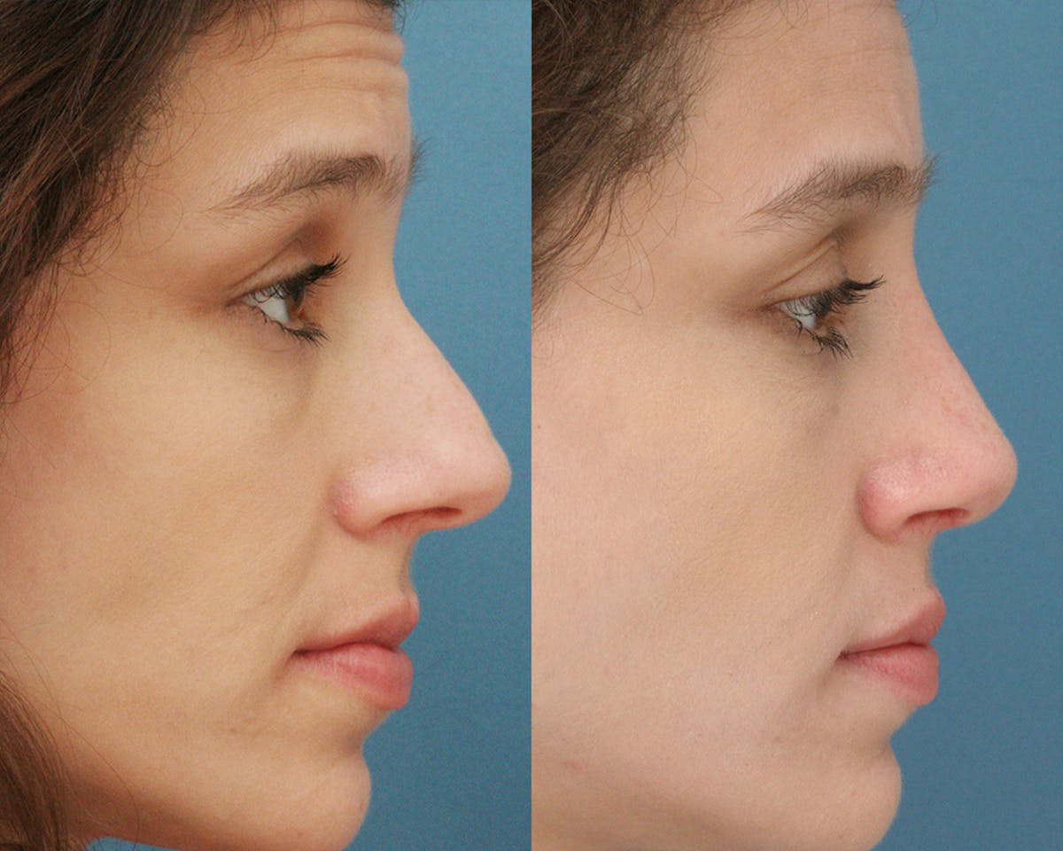 Rhinoplasty Before & After Gallery - Patient 145648 - Image 2