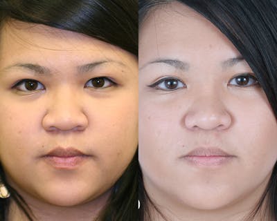 Rhinoplasty Before & After Gallery - Patient 905901 - Image 1