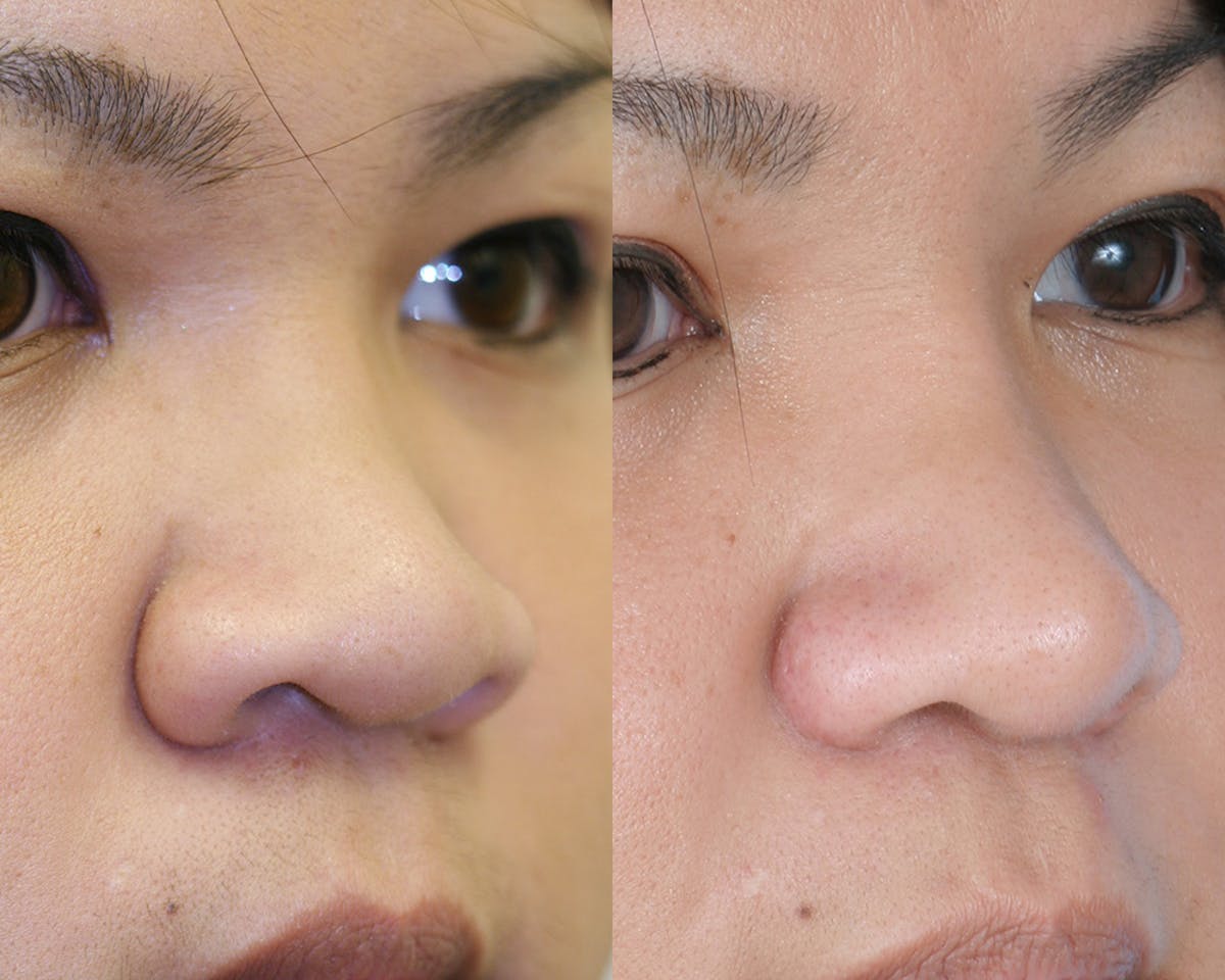 Rhinoplasty Before & After Gallery - Patient 905901 - Image 2