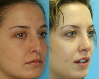 Rhinoplasty Before & After Gallery - Patient 361582 - Image 1