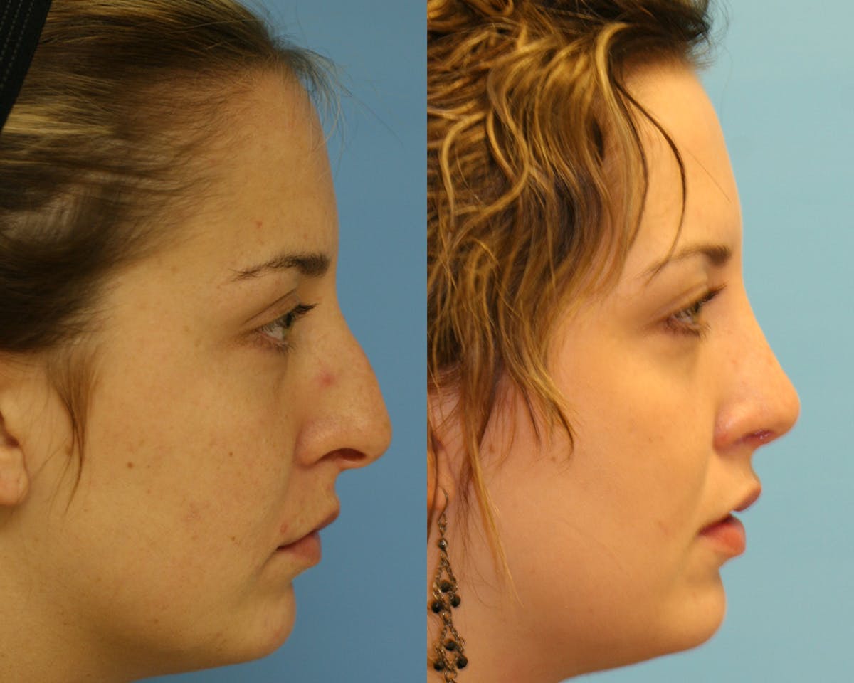 Rhinoplasty Before & After Gallery - Patient 361582 - Image 3