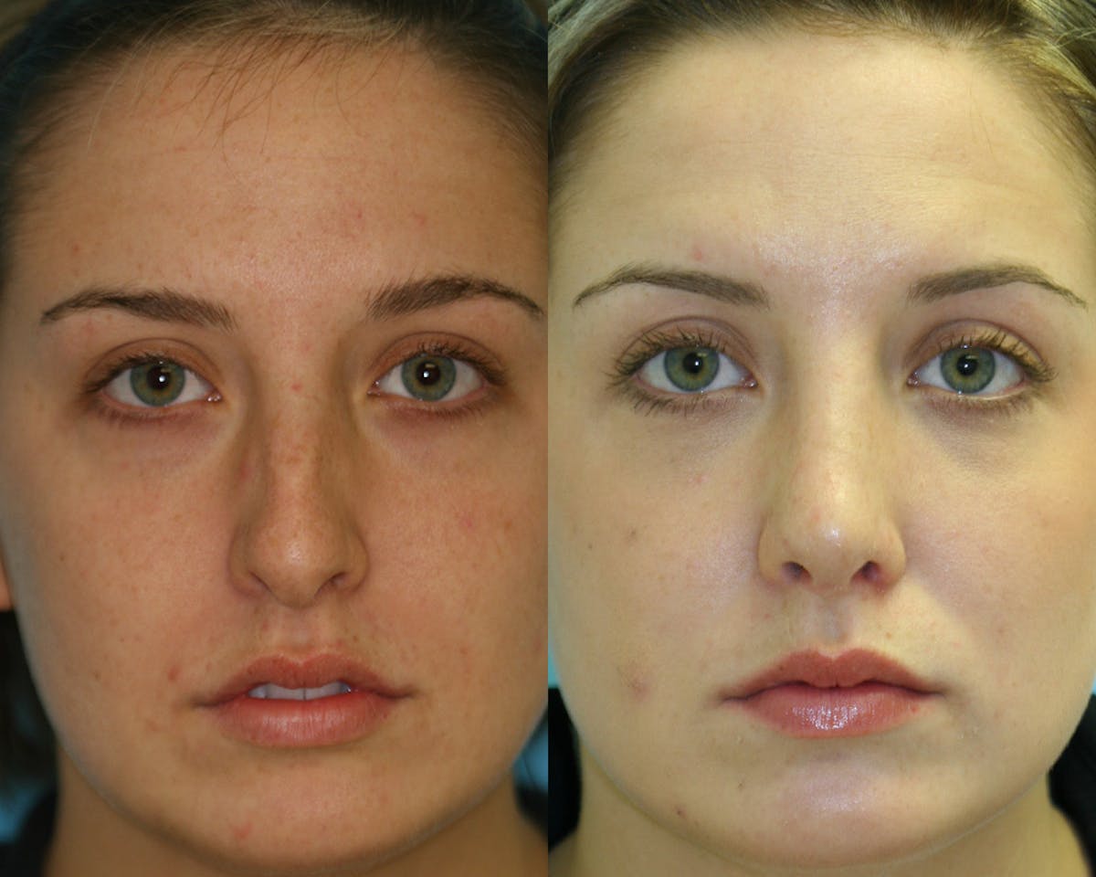 Rhinoplasty Before & After Gallery - Patient 361582 - Image 2