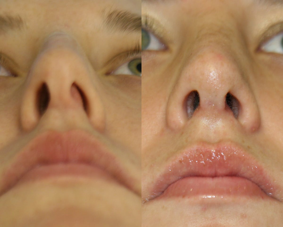 Rhinoplasty Before & After Gallery - Patient 361582 - Image 4