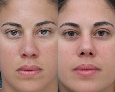 Rhinoplasty Before & After Gallery - Patient 165639 - Image 1