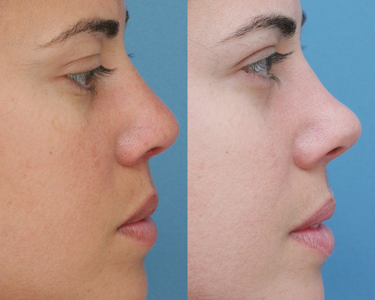Rhinoplasty Before & After Gallery - Patient 165639 - Image 2