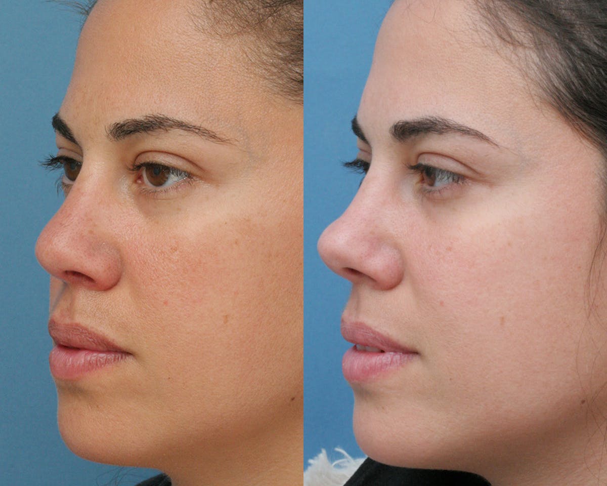 Rhinoplasty Before & After Gallery - Patient 165639 - Image 3