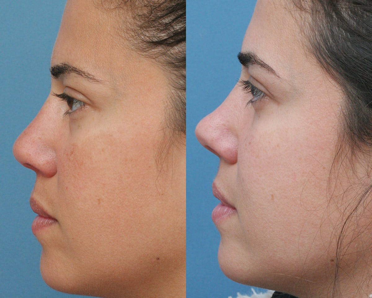 Rhinoplasty Before & After Gallery - Patient 165639 - Image 4