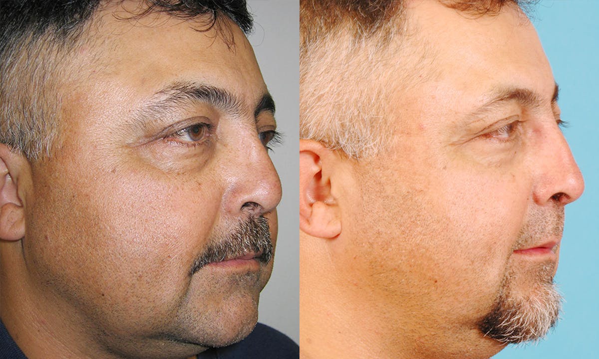 Rhinoplasty Before & After Gallery - Patient 415762 - Image 2