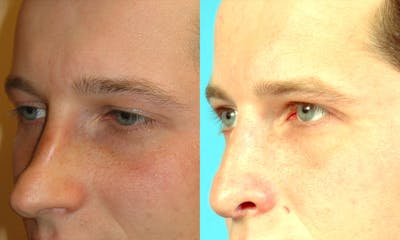 Rhinoplasty Before & After Gallery - Patient 327493 - Image 1