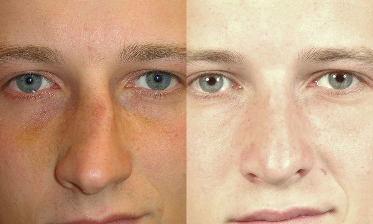 Rhinoplasty Before & After Gallery - Patient 327493 - Image 2