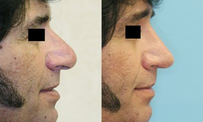 Rhinoplasty Before & After Gallery - Patient 176494 - Image 1
