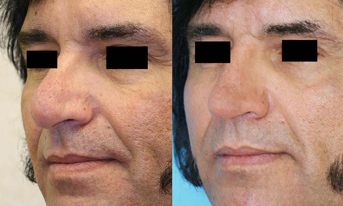 Rhinoplasty Before & After Gallery - Patient 176494 - Image 2