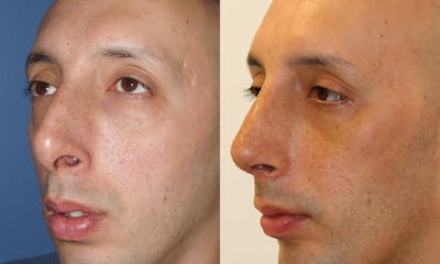 Rhinoplasty Before & After Gallery - Patient 214141 - Image 1