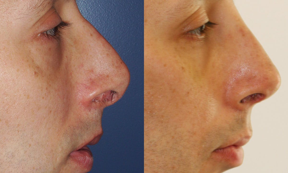 Rhinoplasty Before & After Gallery - Patient 214141 - Image 3
