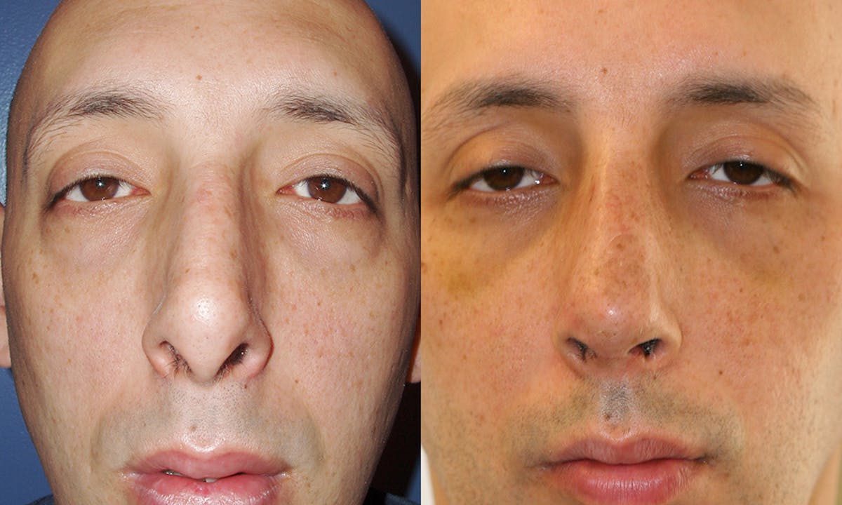 Rhinoplasty Before & After Gallery - Patient 214141 - Image 2