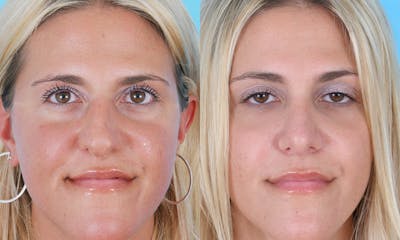 Rhinoplasty Before & After Gallery - Patient 447868 - Image 1