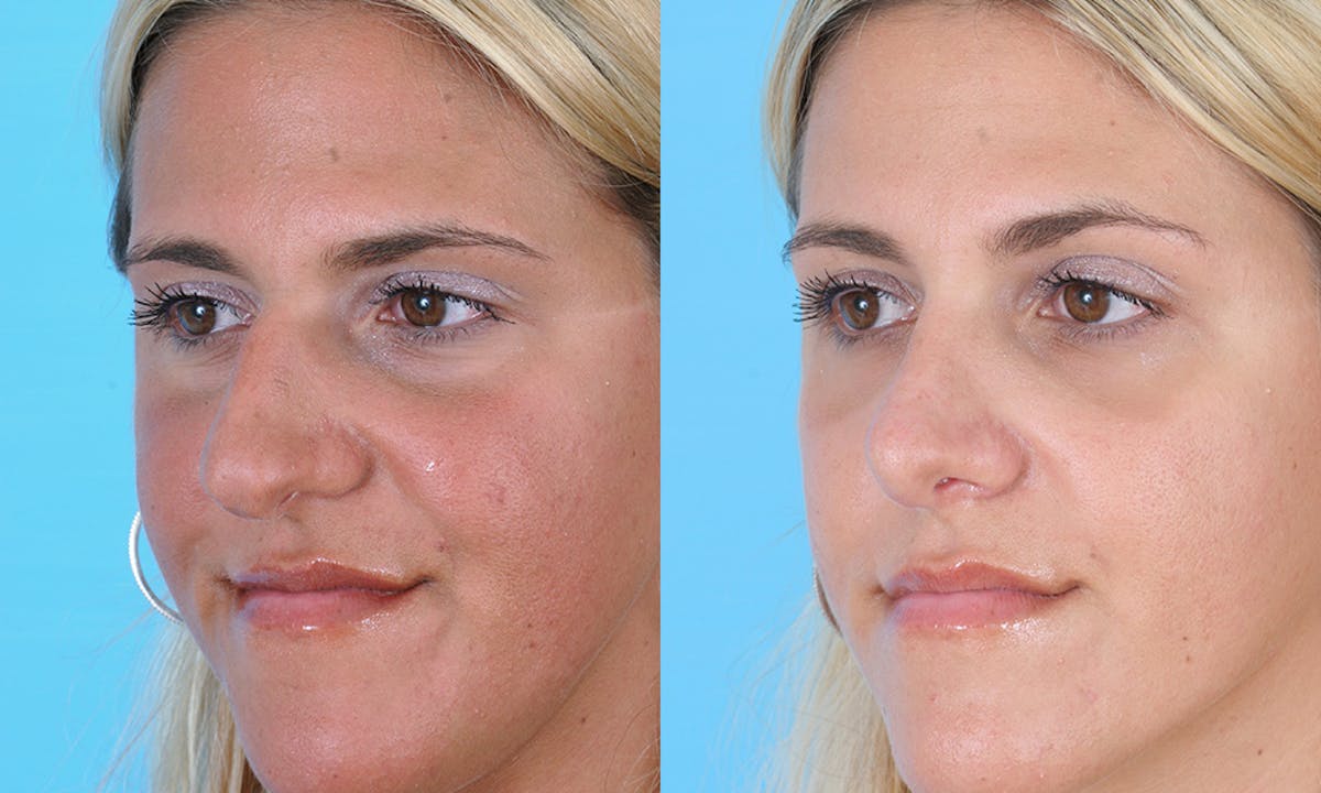Rhinoplasty Before & After Gallery - Patient 447868 - Image 3