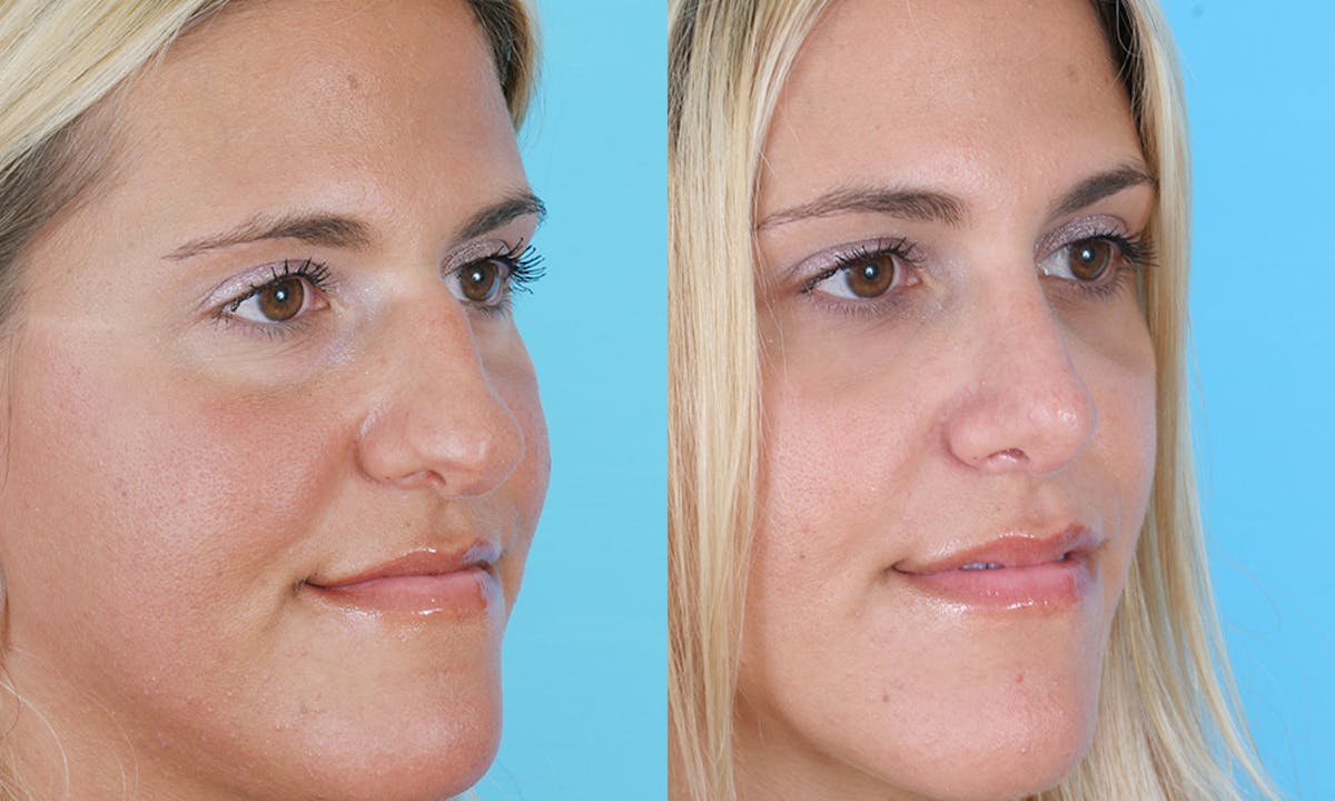 Rhinoplasty Before & After Gallery - Patient 447868 - Image 2