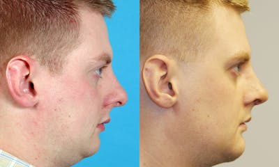 Rhinoplasty Before & After Gallery - Patient 494413 - Image 1