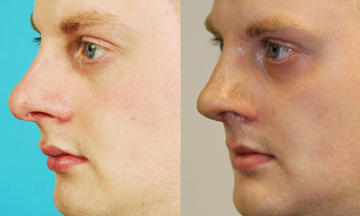 Rhinoplasty Before & After Gallery - Patient 494413 - Image 3