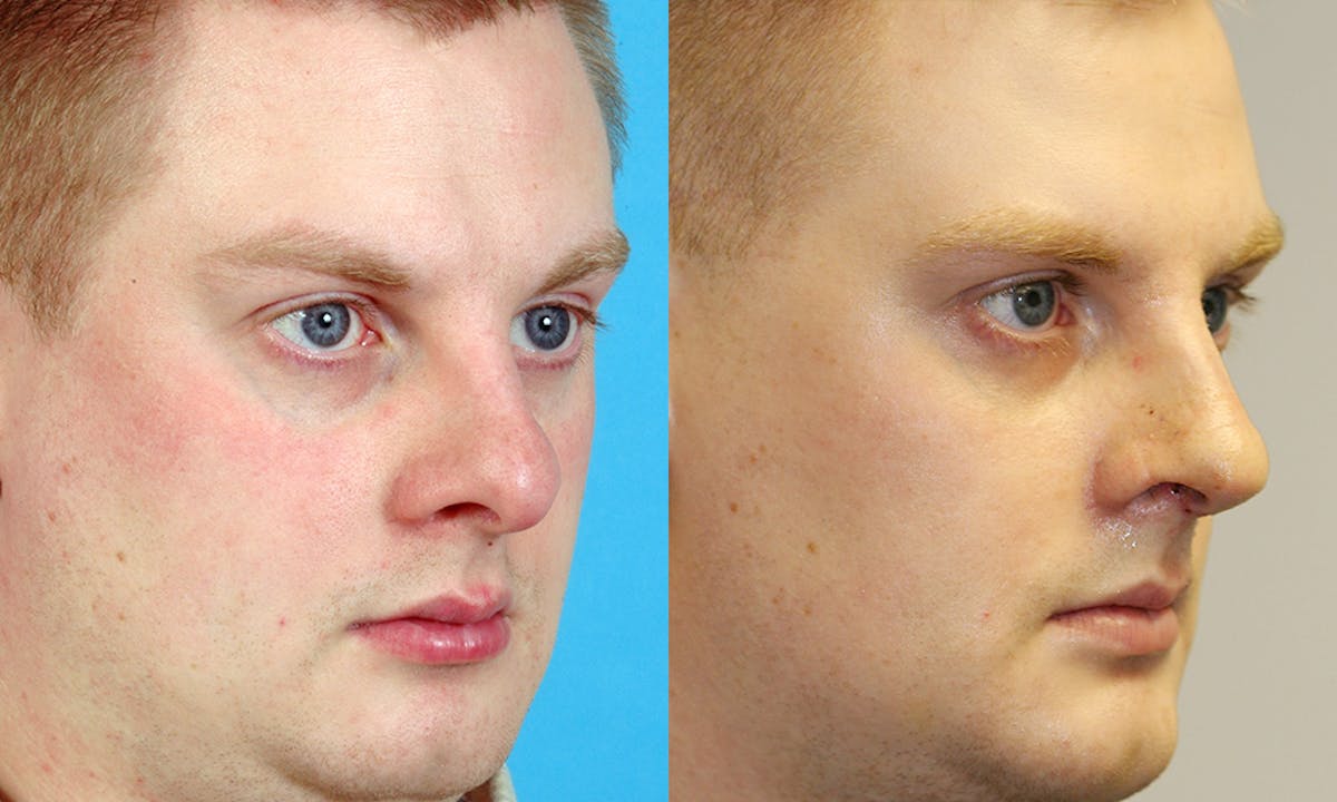 Rhinoplasty Before & After Gallery - Patient 494413 - Image 2