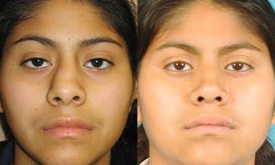 Rhinoplasty Before & After Gallery - Patient 915943 - Image 1