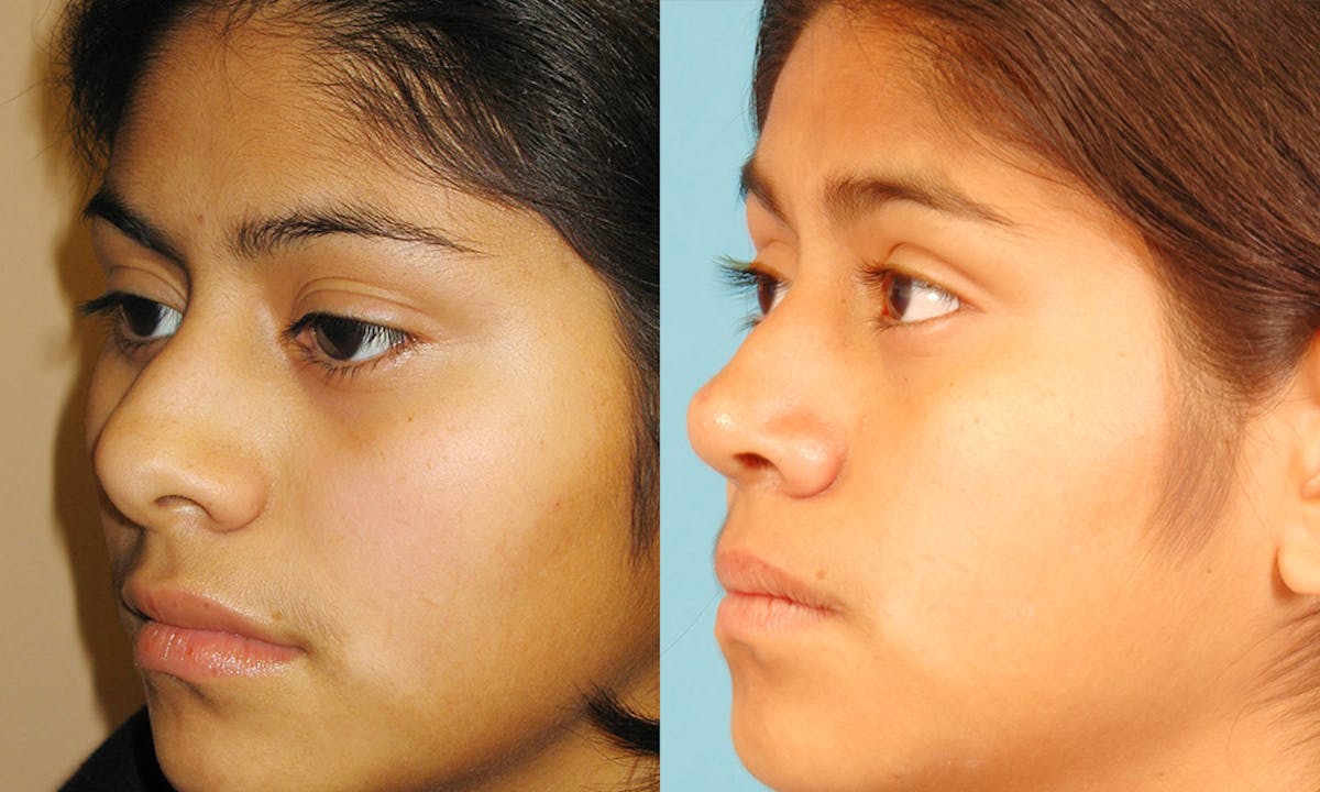 Rhinoplasty Before & After Gallery - Patient 915943 - Image 2
