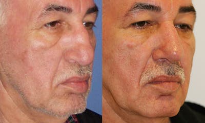 Rhinoplasty Before & After Gallery - Patient 191146 - Image 1
