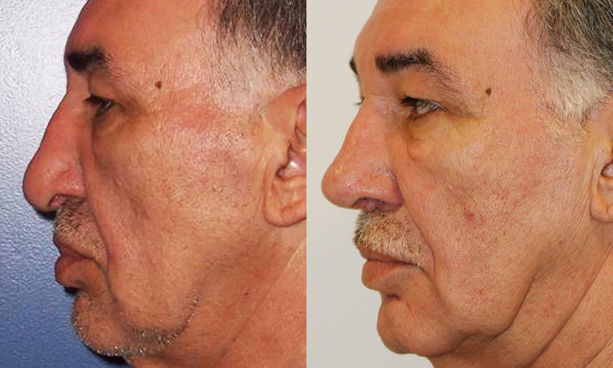 Rhinoplasty Before & After Gallery - Patient 191146 - Image 2