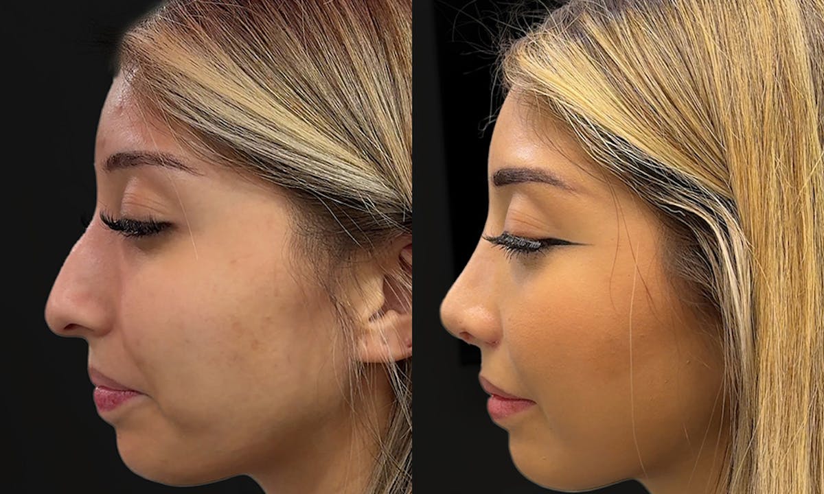 Rhinoplasty Before & After Gallery - Patient 657387 - Image 1