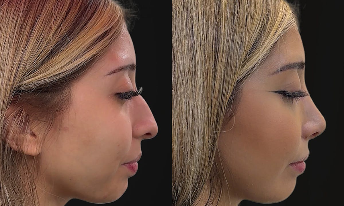 Rhinoplasty Before & After Gallery - Patient 657387 - Image 2